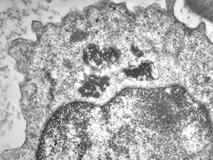M,18y. | blood - tubular inclusions in lymphocytes